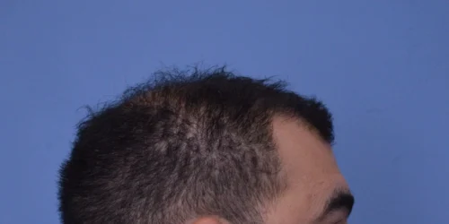 Hair Transplant