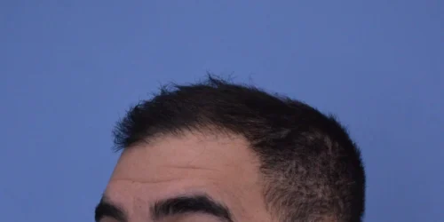 Hair Transplant