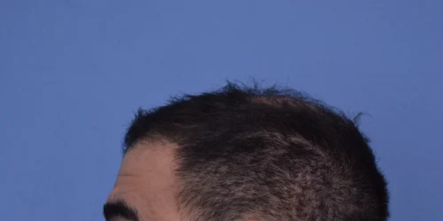 Hair Transplant