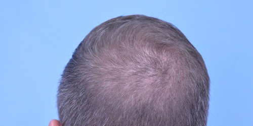 Hair Transplant