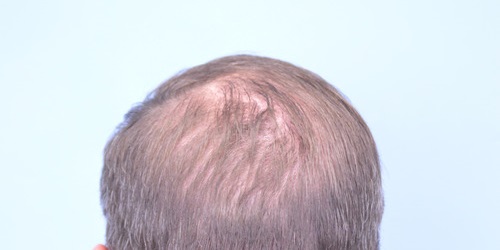 Hair Transplant