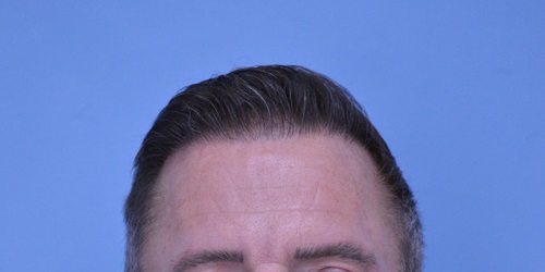 Hair Transplant