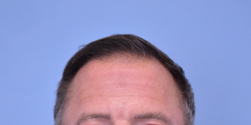 Hair Transplant