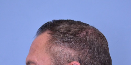 Hair Transplant