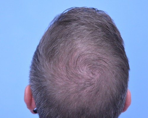 Hair Transplant