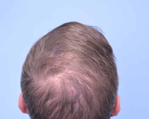 Hair Transplant