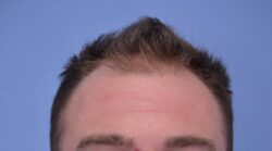 Hair Transplant