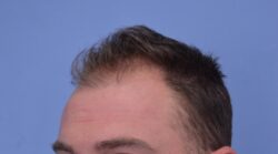 Hair Transplant