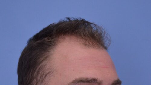 Hair Transplant