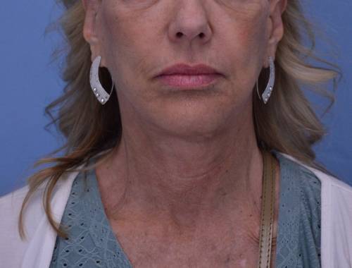 Face and Neck Lift