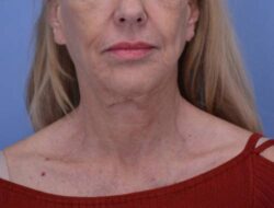 Face and Neck Lift