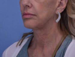 Face and Neck Lift