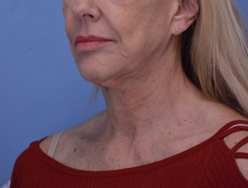 Face and Neck Lift