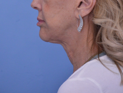 Face and Neck Lift