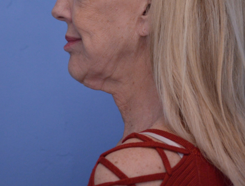 Face and Neck Lift