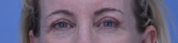 Blepharoplasty