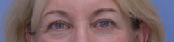 Blepharoplasty