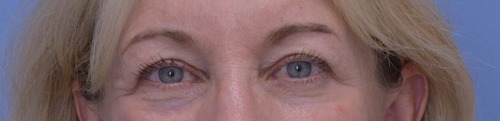 Blepharoplasty