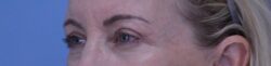 Blepharoplasty