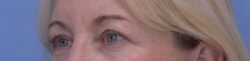 Blepharoplasty