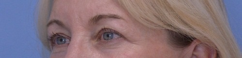 Blepharoplasty