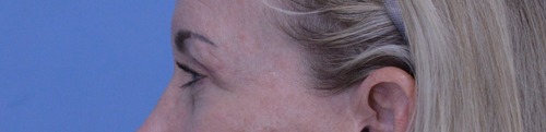 Blepharoplasty