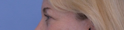 Blepharoplasty