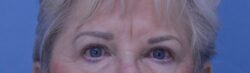 Blepharoplasty