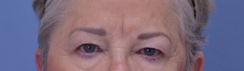 Blepharoplasty