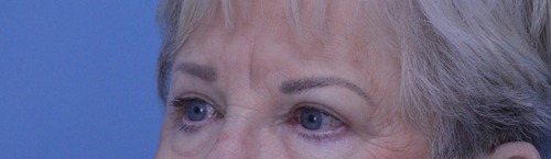 Blepharoplasty