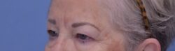 Blepharoplasty