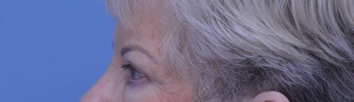 Blepharoplasty