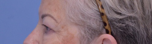 Blepharoplasty