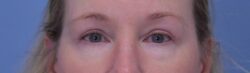 Blepharoplasty