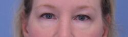 Blepharoplasty