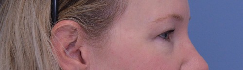 Blepharoplasty