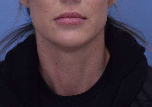 Chin Augmentation