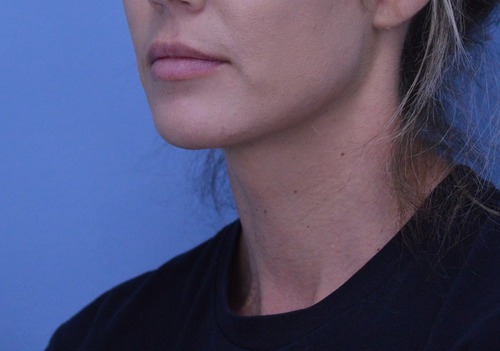 Chin Augmentation