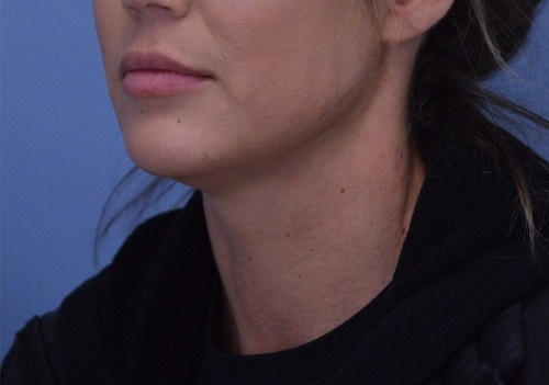 Chin Augmentation