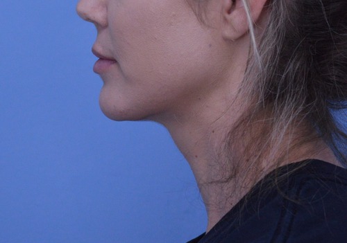 Chin Augmentation