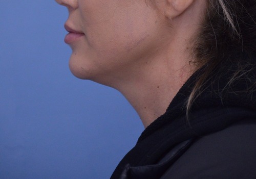 Chin Augmentation